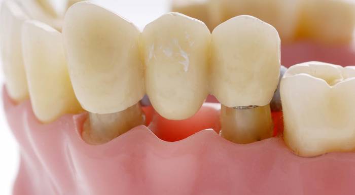 Міст для зубів: фото, види, опис, як ставлять